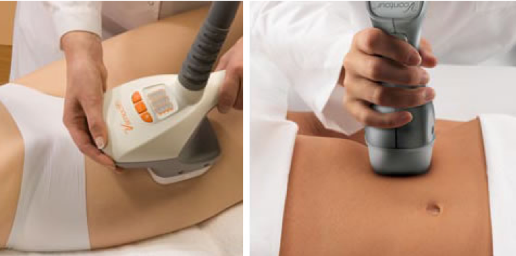 Velashape e cellulite, adiposità, lassità