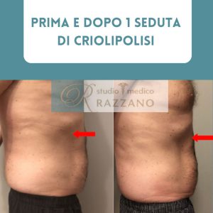 Medicina-estetica-criolipolisi-2